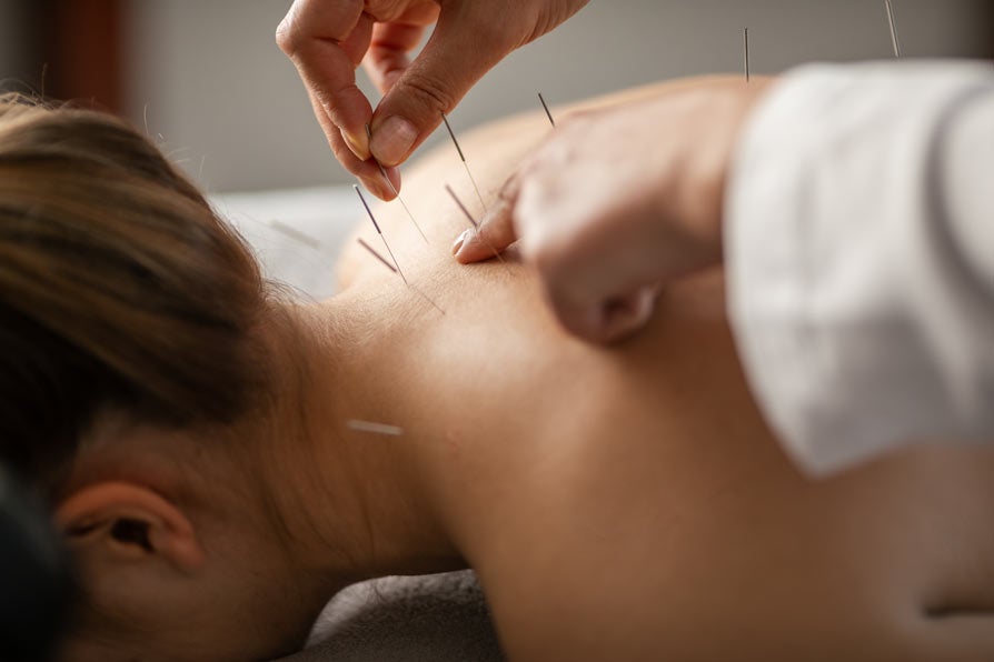 Accupunture needles being placed on woman's shoulder